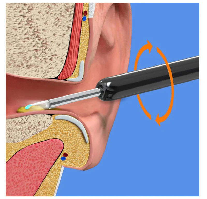 Earwax Removal Kit ksa - Image 4